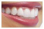 Porcelain Veneers Tampa © drjanicebrand how much are porcelain veneers per tooth