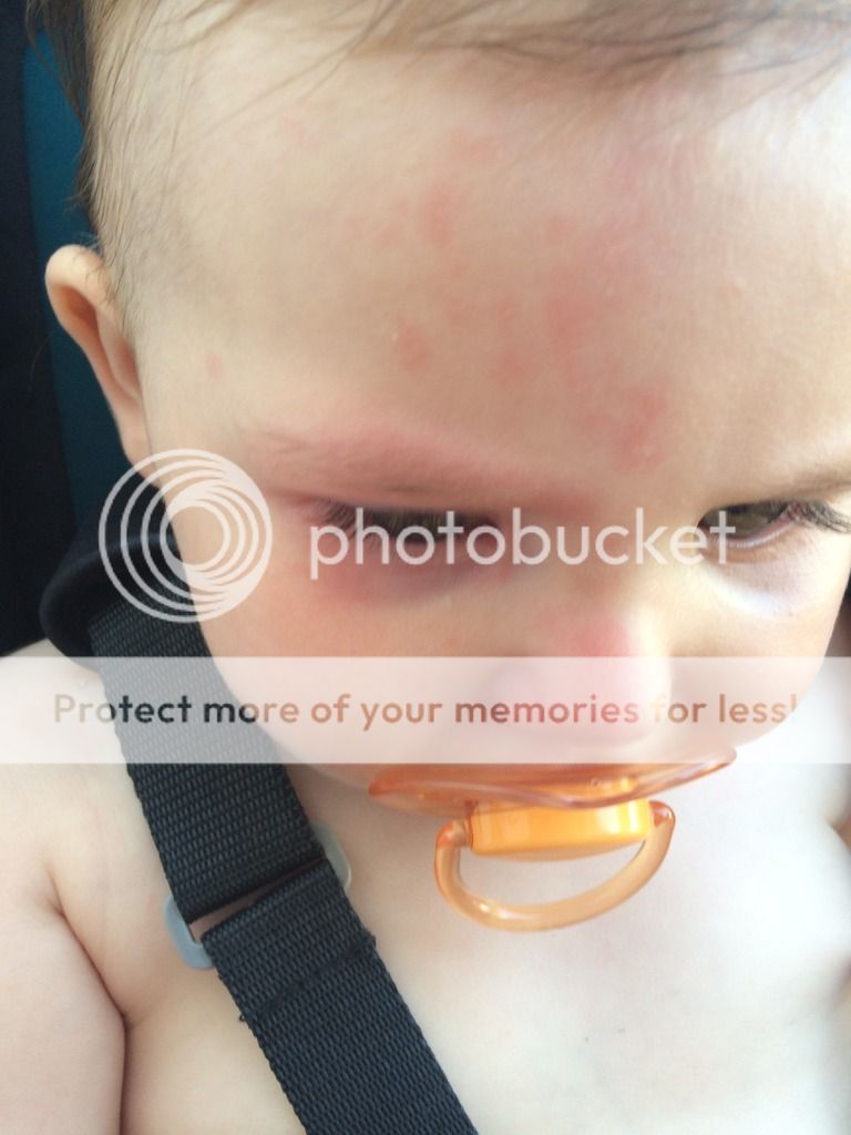 Hayfever Rash On Face Pics Included