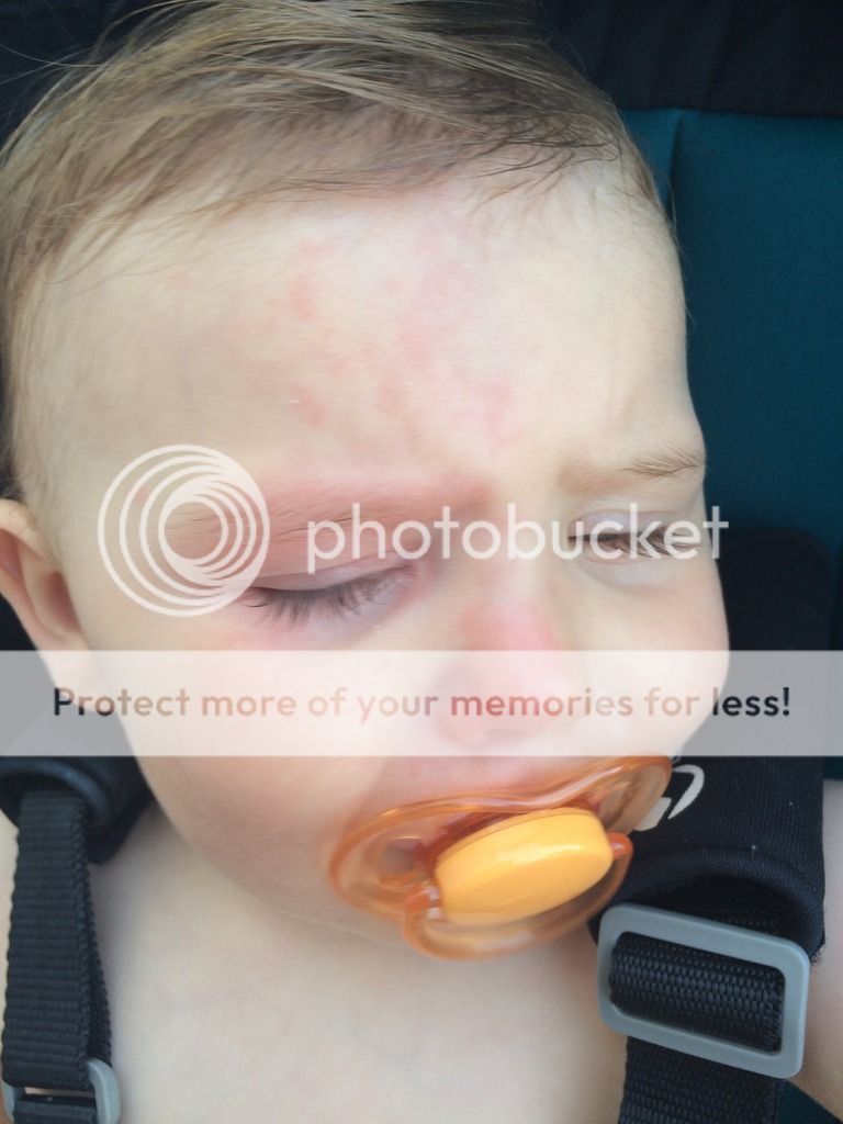 hayfever-rash-on-face-pics-included-babycentre